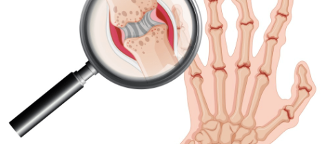 Liečba práškom z včelieho jedu pri artritíde
