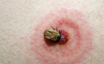 Liečba včelím jedom na lymskú boreliózu (BORRELIA BURGDORFERI)