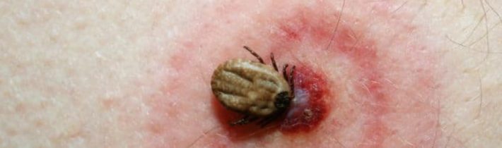 Liečba včelím jedom na lymskú boreliózu (BORRELIA BURGDORFERI)