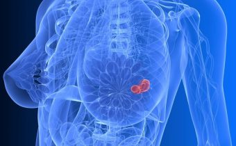 Včelí jed pri rakovine prsníka