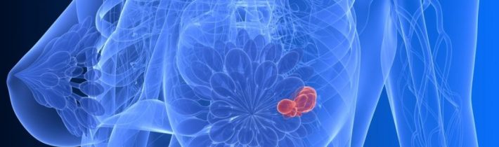 Včelí jed pri rakovine prsníka