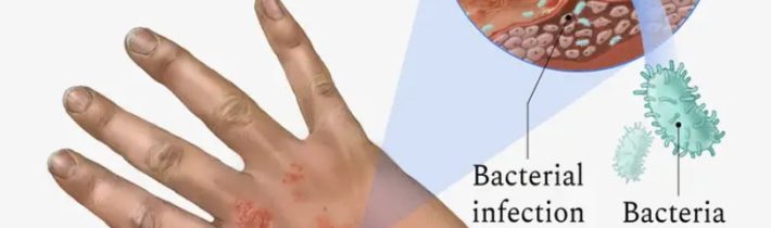 Liečba včelím jedom na atopickú dermatitídu (EKZÉM)