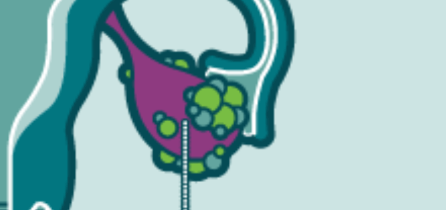 Liečba včelím jedom na rakovinu vaječníkov